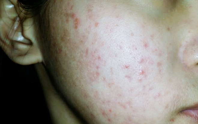 Tẩy trang theo cách này thì đừng hỏi tại sao da lên mụn, chảy xệ và lão hoá-4