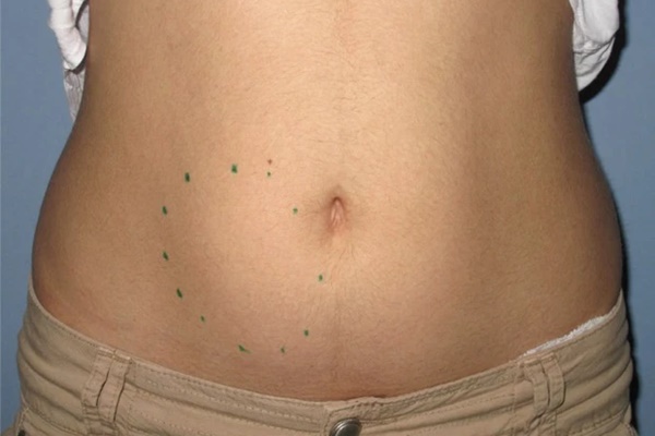 3 tín hiệu ở vùng dưới cơ thể ngầm cảnh báo nguy cơ mắc ung thư phụ khoa rất cao-3