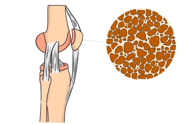 3 thủ phạm bòn rút canxi của cơ thể, người già càng cần chú ý để tránh ngã nhẹ cũng gây gãy xương-2