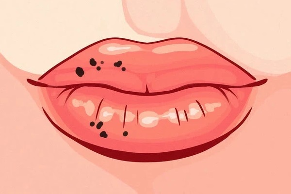 5 bất thường ở môi cảnh báo nhiều loại bệnh tật nguy hiểm nhưng ít người biết-3