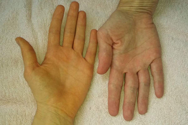 4 tín hiệu sức khỏe là hồi chuông cảnh báo bệnh ung thư tuyến tụy sắp gõ cửa, xem thử bạn có biểu hiện nào không-2