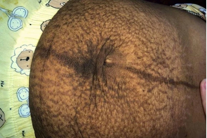 Mẹ bỉm sợ hãi, tự ti vì bụng vừa đen vừa xổ, rạn ngứa gây đau đớn sau sinh đôi 2 con trai-1