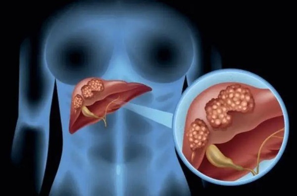 Người phụ nữ 31 tuổi qua đời vì ung thư gan, nguyên nhân xuất phát từ 1 loại cốc mà nhiều gia đình vẫn sử dụng hàng ngày-2