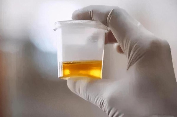 Người phụ nữ 31 tuổi qua đời vì ung thư gan, nguyên nhân xuất phát từ 1 loại cốc mà nhiều gia đình vẫn sử dụng hàng ngày-4