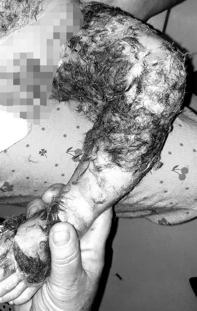 Thầy lang chữa bỏng bằng lông động vật, cháu bé 8 tháng tuổi nguy kịch-1