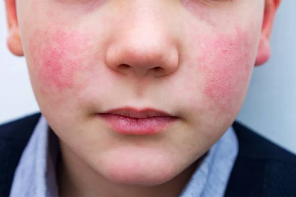 Dấu hiệu trên da cảnh báo bạn phải đi xét nghiệm máu ngay-1