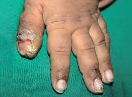 Bí ẩn căn bệnh tự ăn thịt chính mình gây kinh hãi đến ngày nay, đáng sợ nhất là đối tượng mắc bệnh chỉ toàn trẻ nhỏ-3