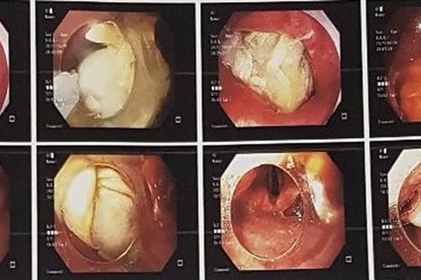 Hóc thịt trâu nhưng đến viện muộn, thực quản mủn nát dẫn tới tử vong: Làm gì khi bị hóc?-1