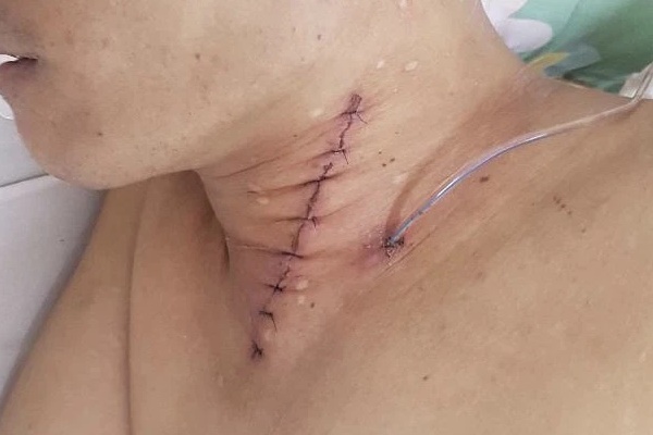 Hóc thịt trâu nhưng đến viện muộn, thực quản mủn nát dẫn tới tử vong: Làm gì khi bị hóc?-2