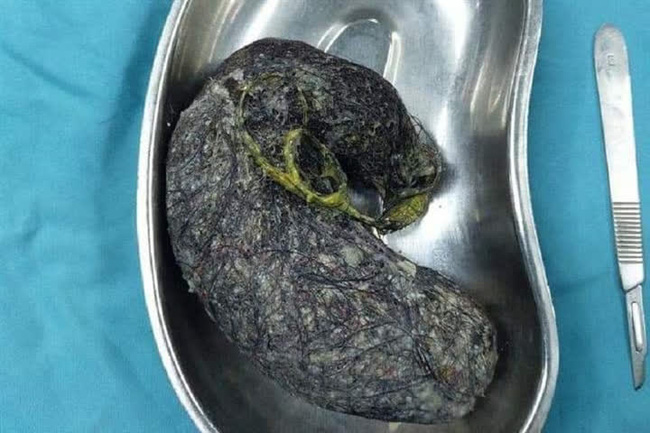 Quảng Ngãi: Búi tóc nặng 0,5kg nằm trong dạ dày bé gái 7 tuổi-1