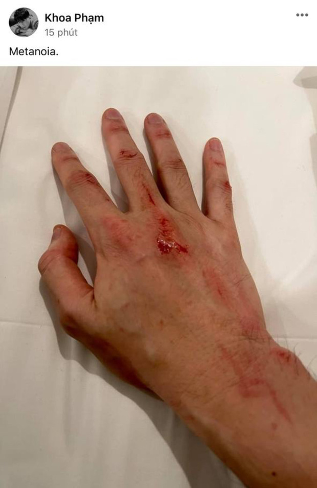 Bạn từng bị bàn tay trầy xước vì một sự cố nào đó? Hãy xem hình ảnh liên quan để tìm kiếm phương án khắc phục các vết trầy xước trên bàn tay của bạn.