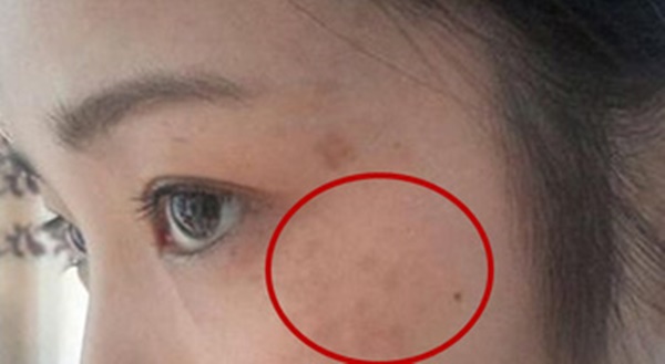 4 biểu hiện trên khuôn mặt cho thấy nữ giới đang mắc bệnh phụ khoa, chỉ cần phát hiện ra 1 cái cũng cần đi khám ngay-2