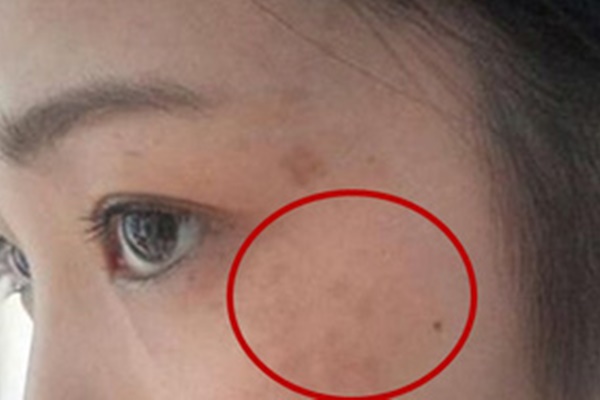 Người phụ nữ bị ngứa ngáy, viêm loét vùng kín phải nhập viện vì 1 sai lầm phổ biến khi dùng băng vệ sinh của chị em ưa sạch sẽ-5