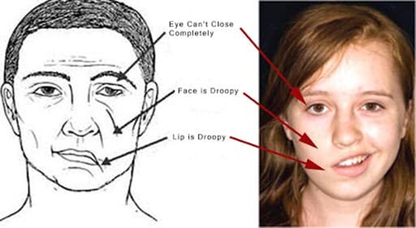 Cô gái bị méo miệng, liệt nửa mặt vì một thói quen ăn uống hàng triệu người trẻ đang có, ngoại hình sau khi can thiệp thẩm mỹ thực sự đáng kinh ngạc-2