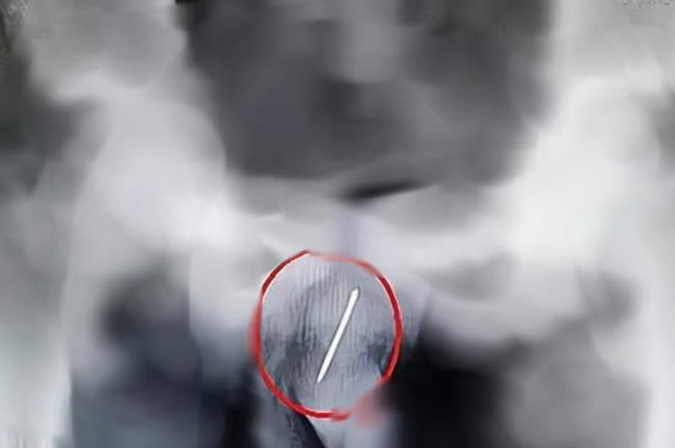 Bé trai 13 tuổi tự nhét dị vật vào vùng kín rồi giấu bố mẹ suốt nửa tháng, đến khi phát hiện bác sĩ gắp ra 1 thứ khiến cả nhà không tin nổi-1