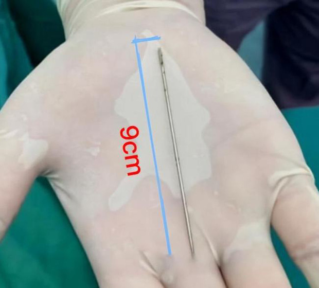 Bé trai 13 tuổi tự nhét dị vật vào vùng kín rồi giấu bố mẹ suốt nửa tháng, đến khi phát hiện bác sĩ gắp ra 1 thứ khiến cả nhà không tin nổi-3