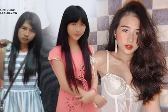Cô gái bị méo miệng, liệt nửa mặt vì một thói quen ăn uống hàng triệu người trẻ đang có, ngoại hình sau khi can thiệp thẩm mỹ thực sự đáng kinh ngạc