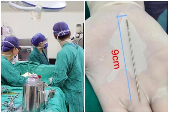 Bé trai 13 tuổi tự nhét dị vật vào vùng kín rồi giấu bố mẹ suốt nửa tháng, đến khi phát hiện bác sĩ gắp ra 1 thứ khiến cả nhà không tin nổi