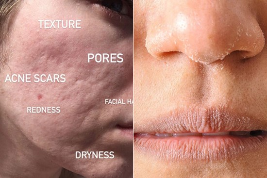 Da bị mất nước: Nếu không làm điều này kịp thời thì da dẻ xuống cấp, già tới cả chục tuổi