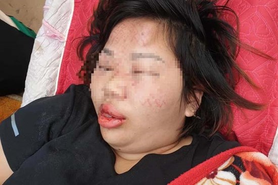 Vụ người phụ nữ bị đối tượng lạ xông vào nhà hành hung dã man: Nạn nhân vẫn bất tỉnh, người nhà cầu cứu