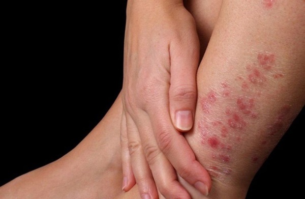 Người có phổi không khỏe thường gặp phải 2 đau, 2 ngứa trên cơ thể, mong rằng bạn không gặp điều nào-3