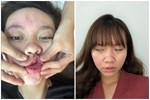 Cô gái 32 tuổi bị liệt mặt, méo miệng chỉ vì thói quen tai hại khi gội đầu buổi tối, xem nguyên nhân bạn sẽ thấy chột dạ ngay-4
