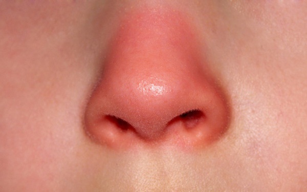 Mũi là đèn tín hiệu của phổi: nếu mũi xuất hiện 3 dấu hiệu lạ thì bạn nên đi kiểm tra phổi ngay-1