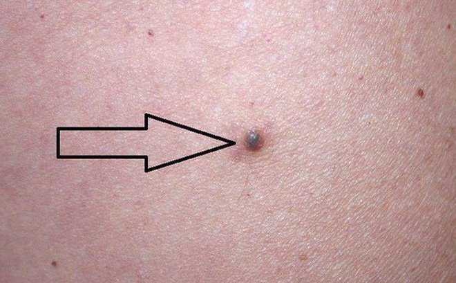 Dắt túi những kiến thức cực hữu ích về cách trị mụn ruồi-1