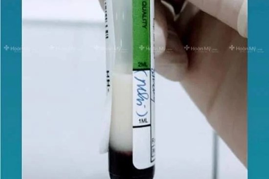 Mẫu máu bất ngờ chuyển màu trắng đục như sữa, bé trai 3 tháng được chẩn đoán mắc bệnh hiếm gặp