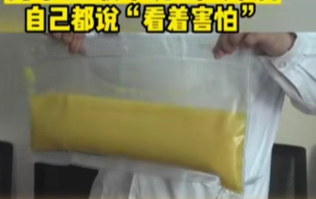 Đi xét nghiệm mỡ máu, ai ngờ bị rút luôn 2 lít mỡ thừa vì ăn uống không lành mạnh-1