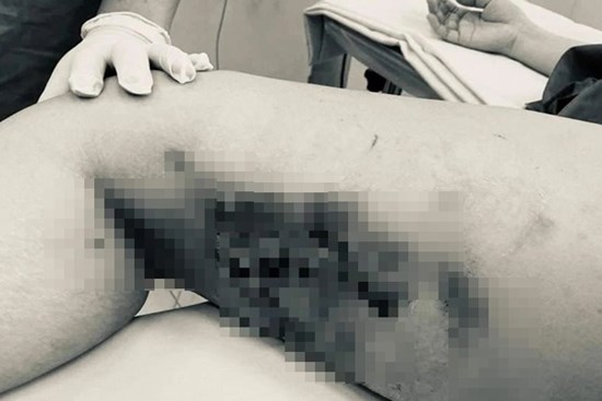 TPHCM: Tiêm thuốc tan mỡ tại thẩm mỹ viện, nhiều phụ nữ bị hoại tử ở bụng, đùi, lưng