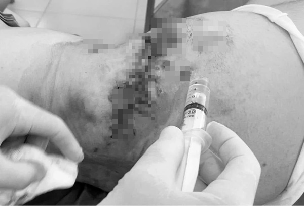 TPHCM: Tiêm thuốc tan mỡ tại thẩm mỹ viện, nhiều phụ nữ bị hoại tử ở bụng, đùi, lưng-1