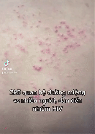 Nam sinh 16 tuổi suy sụp khi hay tin nhiễm HIV, kiểu quan hệ tình dục này chính là nguyên nhân dẫn đến hậu quả đau lòng-1