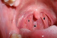 Nam sinh 16 tuổi suy sụp khi hay tin nhiễm HIV, kiểu quan hệ tình dục này chính là nguyên nhân dẫn đến hậu quả đau lòng