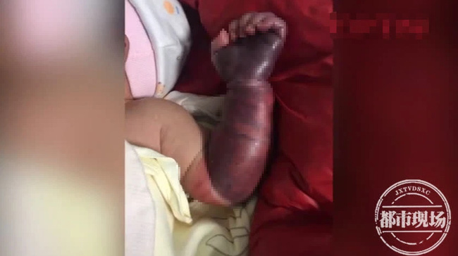 Cánh tay của trẻ 1 ngày tuổi bỗng nhiên bầm đen, khi đưa đến bệnh viện mới biết do sự cẩn thận quá mức của người mẹ-1