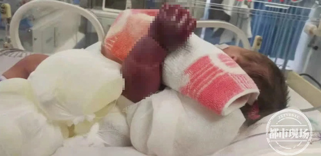 Cánh tay của trẻ 1 ngày tuổi bỗng nhiên bầm đen, khi đưa đến bệnh viện mới biết do sự cẩn thận quá mức của người mẹ-2