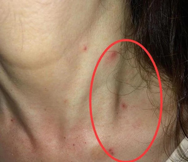 Người sở hữu lá gan khỏe mạnh sẽ không có 2 biểu hiện ở cổ, nếu bạn cũng vậy thì xin chúc mừng-2