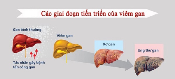 Khám định kỳ vẫn không phát hiện sớm ung thư gan, vì sao?-1