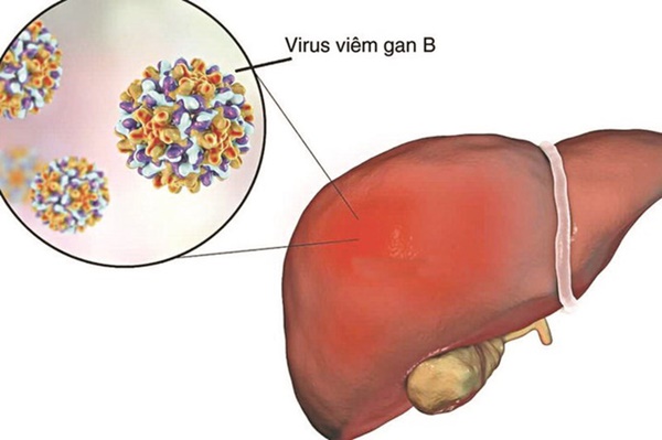 Khám định kỳ vẫn không phát hiện sớm ung thư gan, vì sao?-2