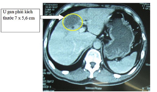 Khám định kỳ vẫn không phát hiện sớm ung thư gan, vì sao?-5