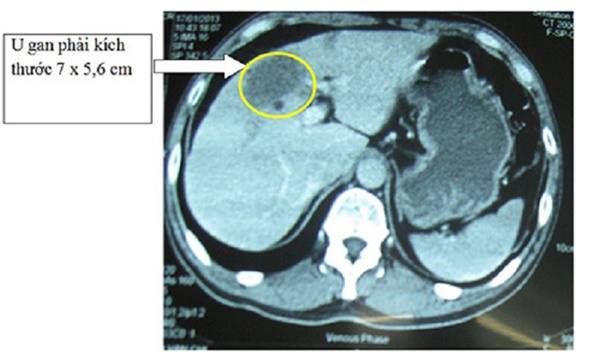 Khám định kỳ vẫn không phát hiện sớm ung thư gan, vì sao?-4
