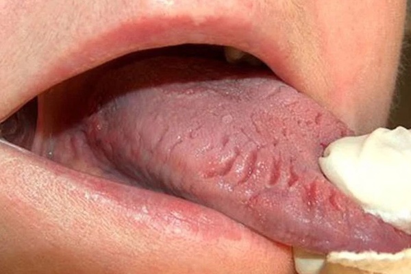 2 tổn thương trên lưỡi ngầm cảnh báo thực quản có vấn đề, đừng chủ quan bỏ qua-2