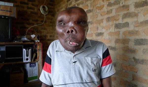 Người đàn ông xấu nhất thế giới” sinh ra đã bị kỳ thị, mấy chục năm sau gây ngỡ ngàng với cuộc đời đáng ghen tỵ-2