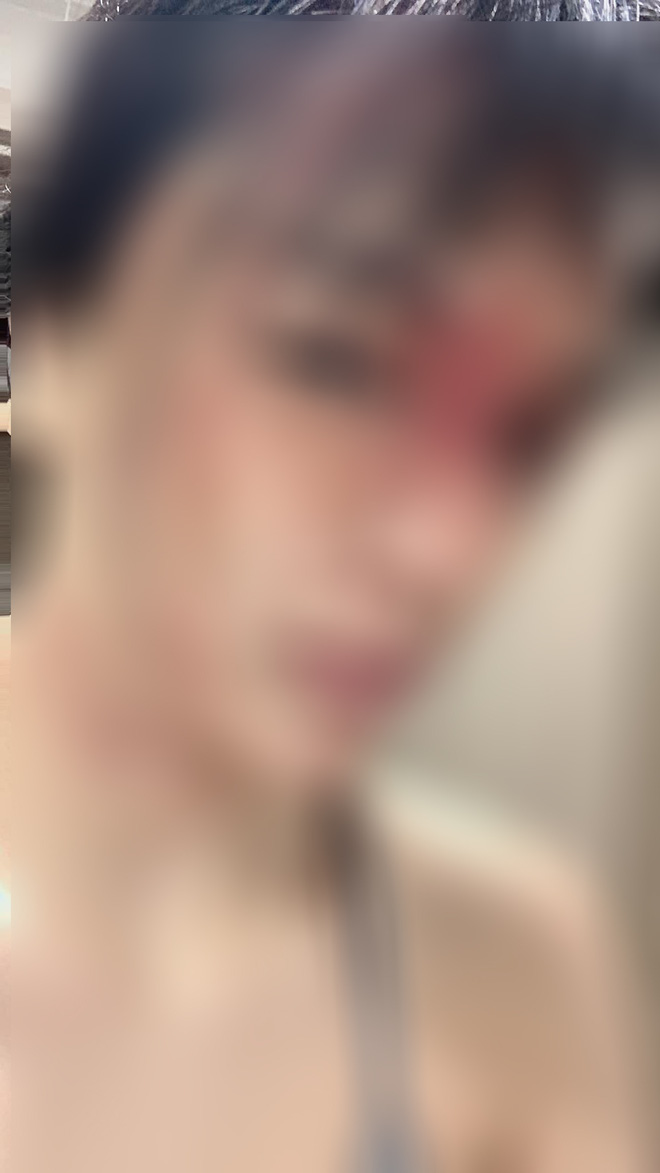 Nữ siêu mẫu Vbiz tung ảnh thương tích đầy mình, bị giam trong nhà đánh đập suốt 1 năm, cắt cả tóc, dí đầu vào bồn cầu-5