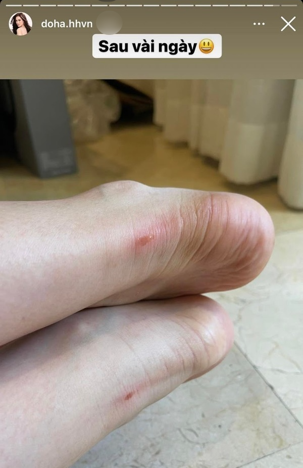 Đỗ Hà lại phá hỏng cả set đồ chỉ vì đôi dép lê loẹt quẹt, nhưng nếu nhìn đôi chân cô trước đó thì ai cũng xót thay-9