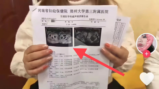 Em chưa 18 đã mang thai 8 vì cố tình lạm dụng thuốc kích rụng trứng, hành động hồn nhiên của mẹ chồng và nàng dâu sau đó khiến cõi mạng dậy sóng-1