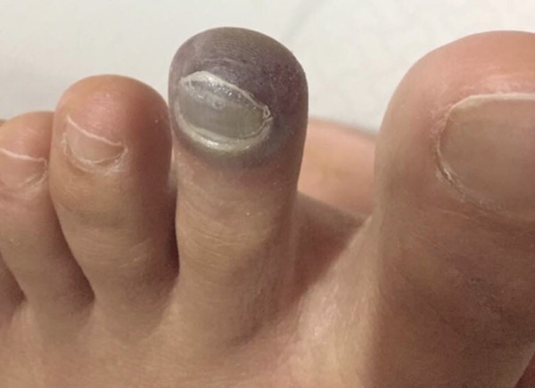 Người đàn ông bị tiểu đường phải cắt cụt ngón chân chỉ vì một vết xước nhỏ, bác sĩ cảnh báo nguy cơ biến chứng bàn chân của căn bệnh này-2