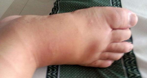 Người đàn ông bị tiểu đường phải cắt cụt ngón chân chỉ vì một vết xước nhỏ, bác sĩ cảnh báo nguy cơ biến chứng bàn chân của căn bệnh này-3