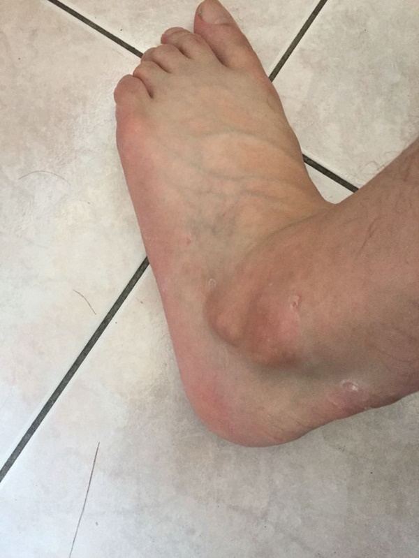 Người đàn ông bị tiểu đường phải cắt cụt ngón chân chỉ vì một vết xước nhỏ, bác sĩ cảnh báo nguy cơ biến chứng bàn chân của căn bệnh này-4