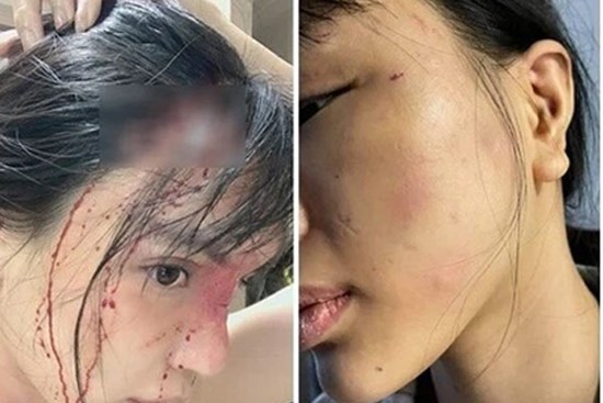 Khả Trang hé lộ tình trạng đáng lo sau khi công khai chuyện bị chồng bạo hành dã man